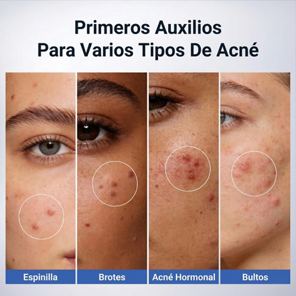 Loción secante para el tratamiento del acné